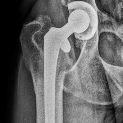 X-ray of a hip replacement